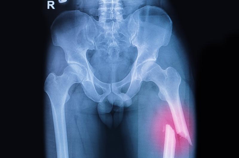 an x-ray of a broken human femur