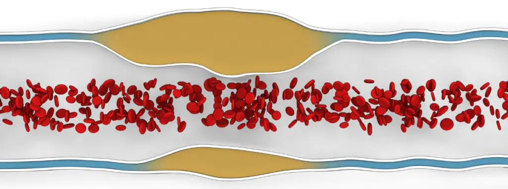 a diagram of red blood cells in a vein with atherosclerosis.