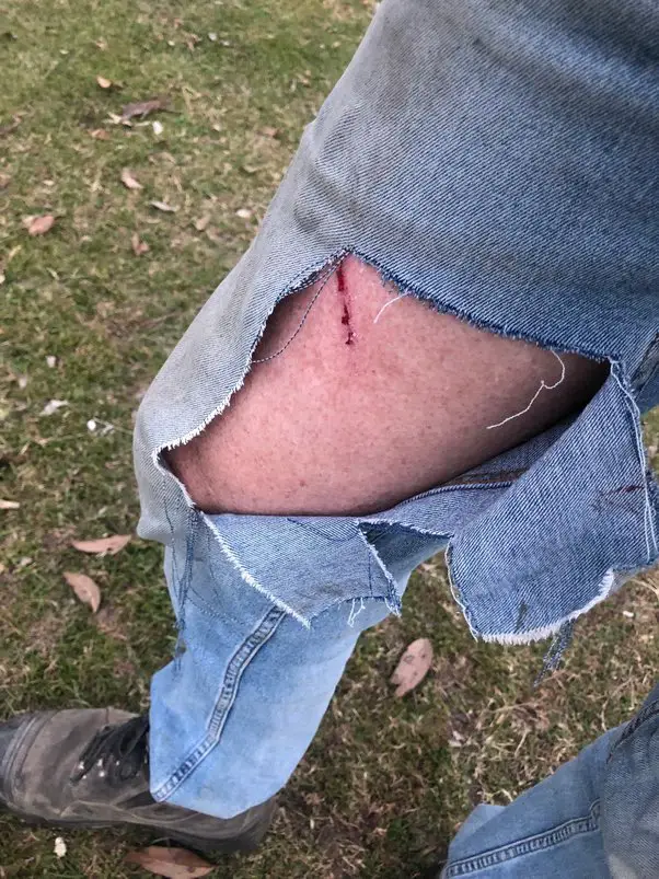 a man with torn jeans and a scratch on his leg from an emu attack
